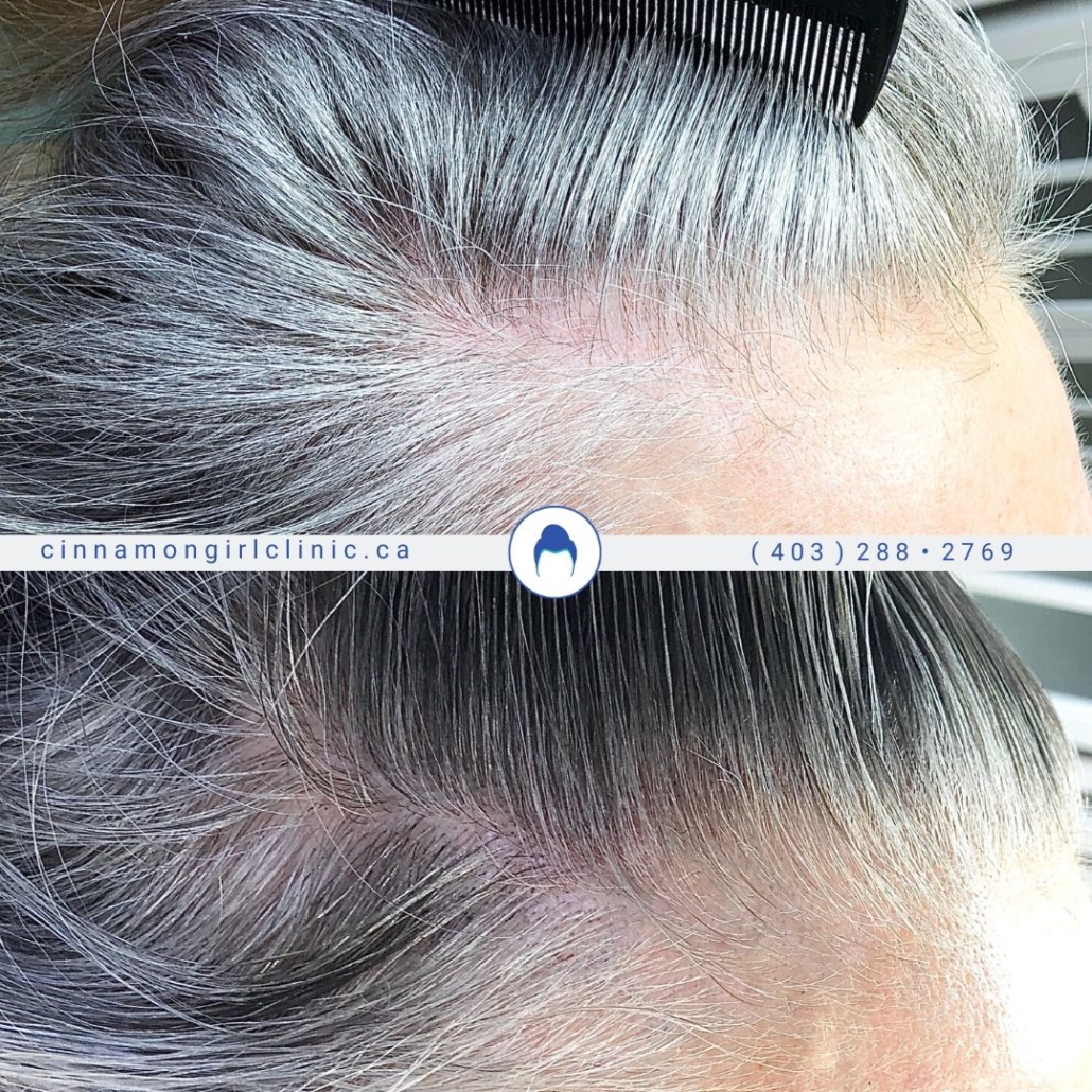 Forehead Reduction Surgery Hair Transplants for Women Reparative Hair  Transplant photos  Miami FL  Patient118821