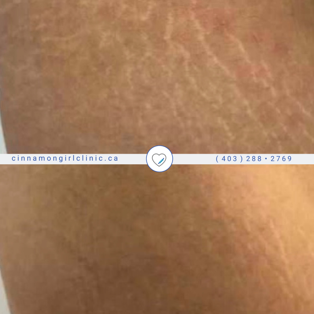 Stretch Marks: Red Vs. White. - Vancouver Permanent Makeup & Paramedical  Tattoos