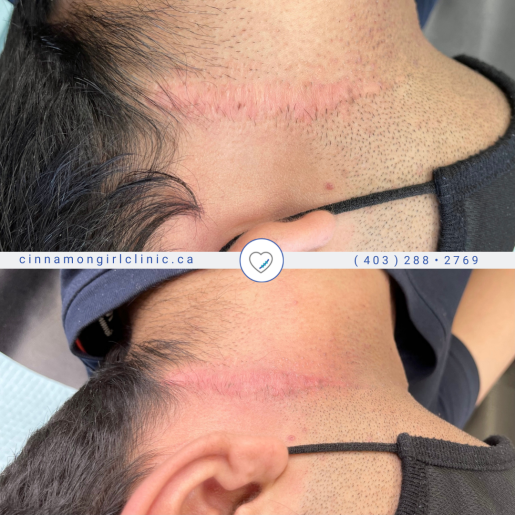 Self harm scar removal