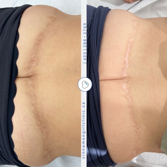 Lipo Scar Camouflage ! Call today to start your treatments or register, Remove Scar Mark